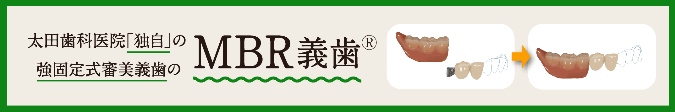 MBR義歯